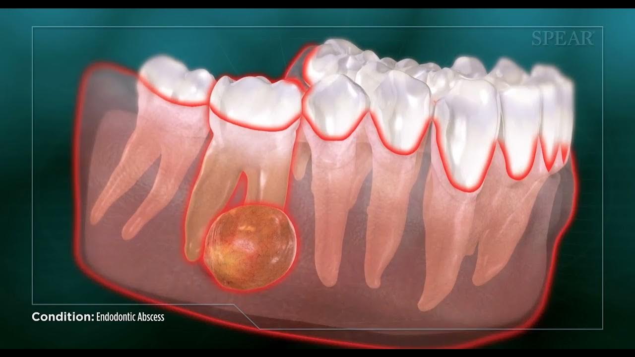 Endodontic Abscess YouTube