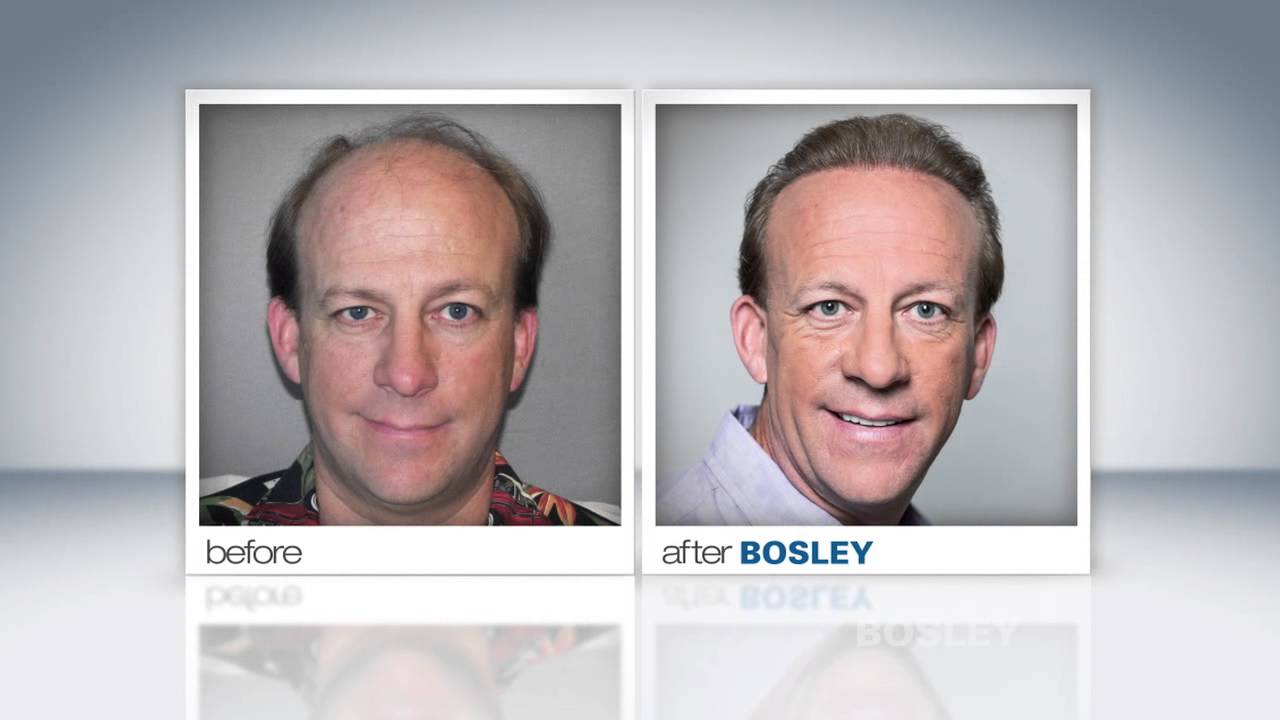bosley-medical-hair-restoration-patient-review-dan-t-youtube