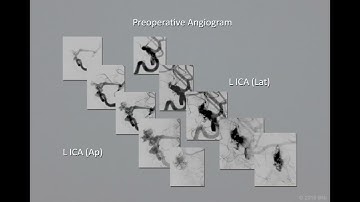 Video 248 2 STA to MCA Bypass for Pediatric Aneurysm