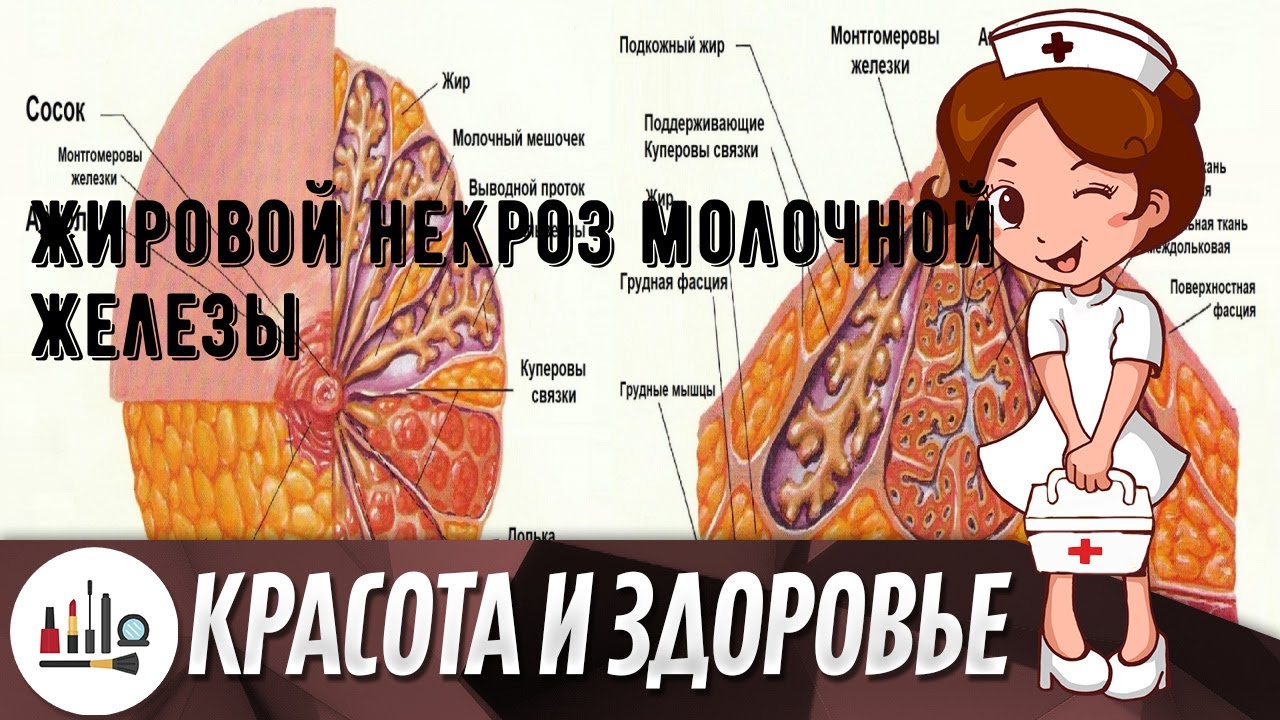 Жировой некроз молочной железы