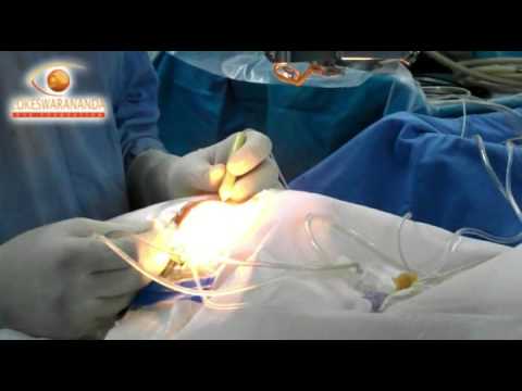 RETINA SURGERY BY DR RUPAK KANTI BISWAS LEF