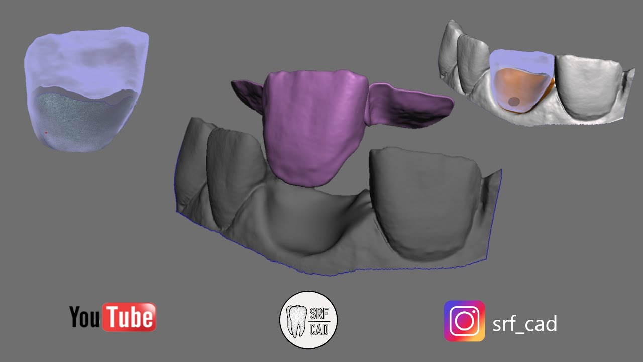 MESHMIXER DENTAL: Tutorial come creare un maryland bridge  e come specchiare mirror un dente