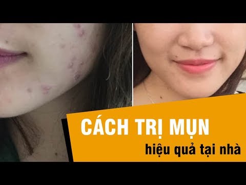 TỔNG HỢP CÁC CÁCH TRỊ SẠCH MỤN TẠI NHÀ CHỈ SAU 1 ĐÊM