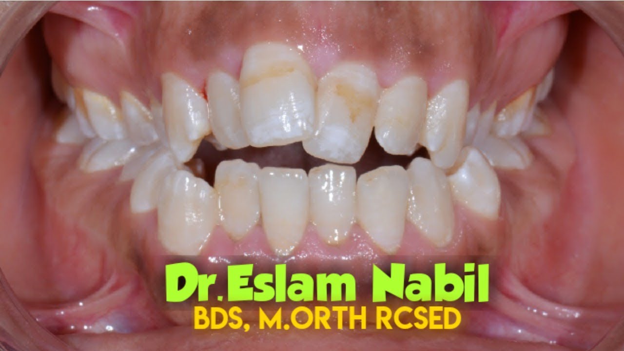 Skeletal Open bite Camouflage Molars Intrusion by TADs علاج العضه