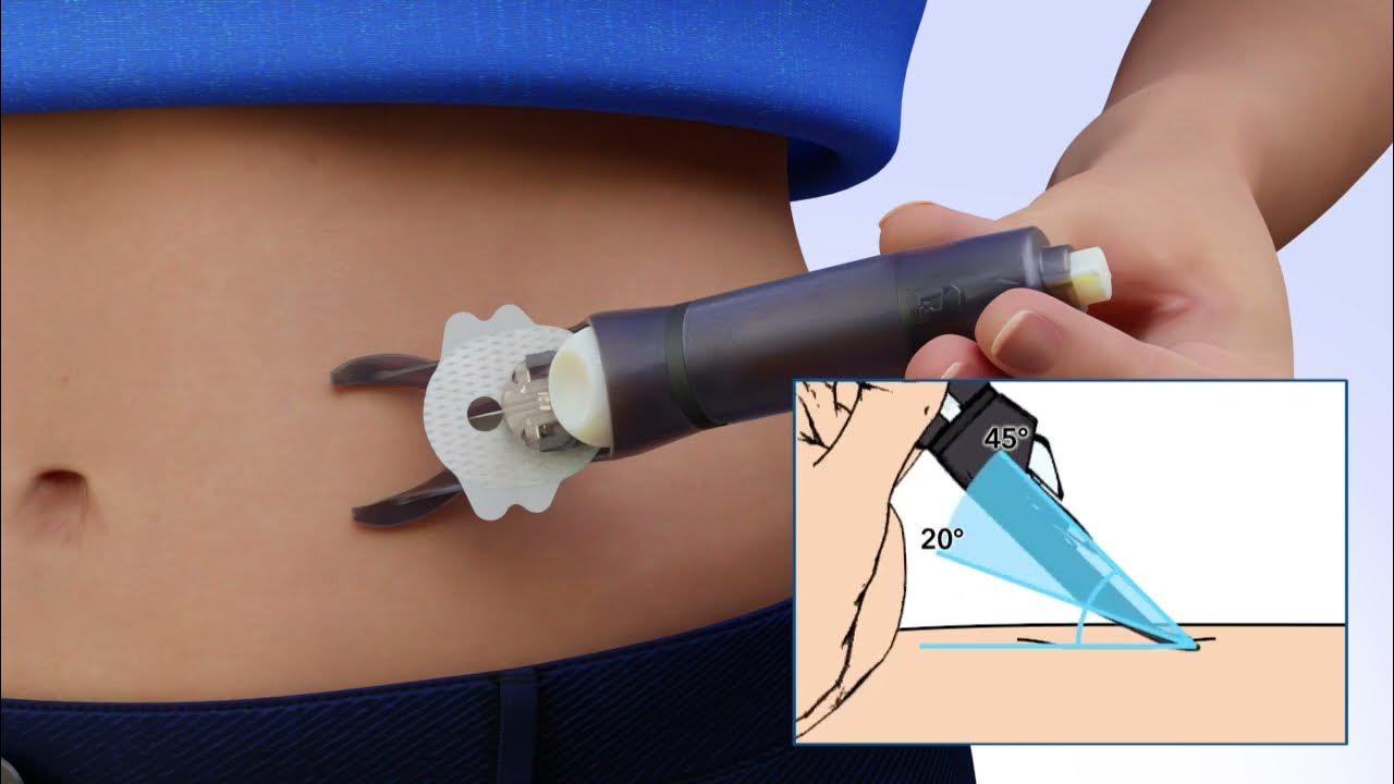 Changing the MiniMed™ Silhouette™ Infusion Set and Reservoir (Sil