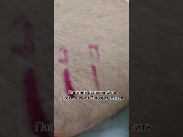 Результат после лигаментотомии.