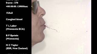 15Aa2 Coughed blood