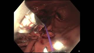 Endoscopic Sleeve Gastroplasty