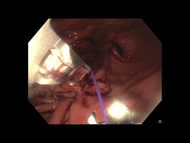 Endoscopic Sleeve Gastroplasty