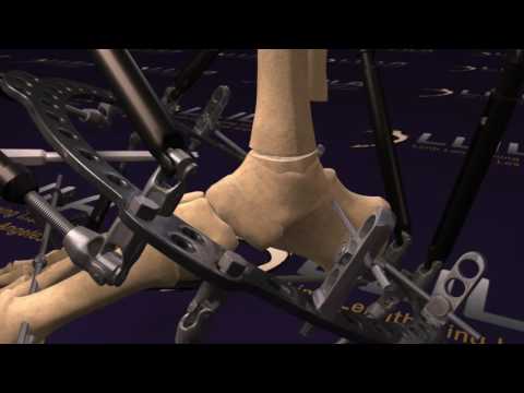 External fixation taylor spatial frame for correction of ankle deformity