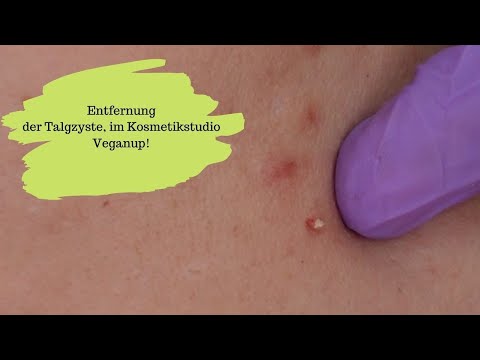 TALGZYSTE ENTFERNEN!  Was ist zu beachten und was ist überhaupt eine Talgzyste?