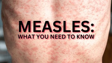 #Measles: What you need to know