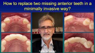 How to replace two missing anterior teeth in a minimally invasive way?