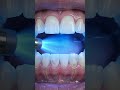 🚨TOOTH POLISHING AND RESTORATION#medical#dentist#dental#teeth#viral#shorts#youtubeshorts#whitesmile