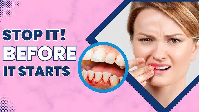 5 Ways To Prevent Early Signs Of Gingivitis Effective 2024