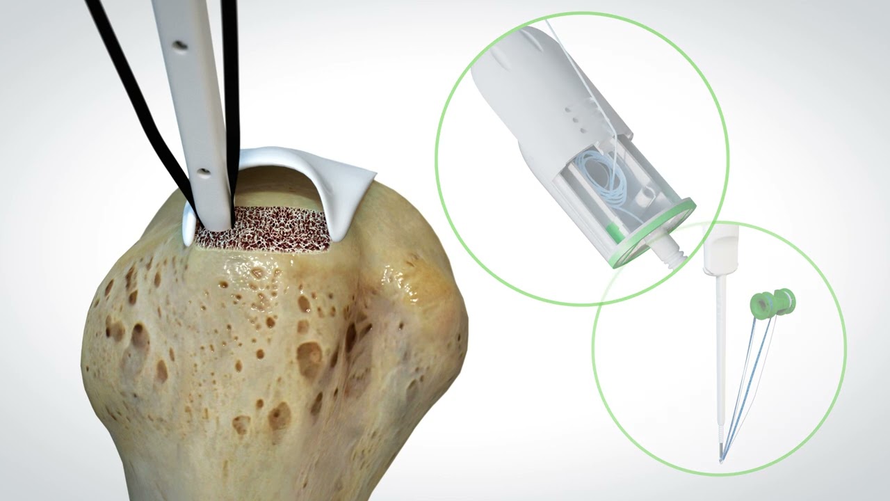 OSSIOfiber® Suture Anchor Animation for Rotator Cuff Repair