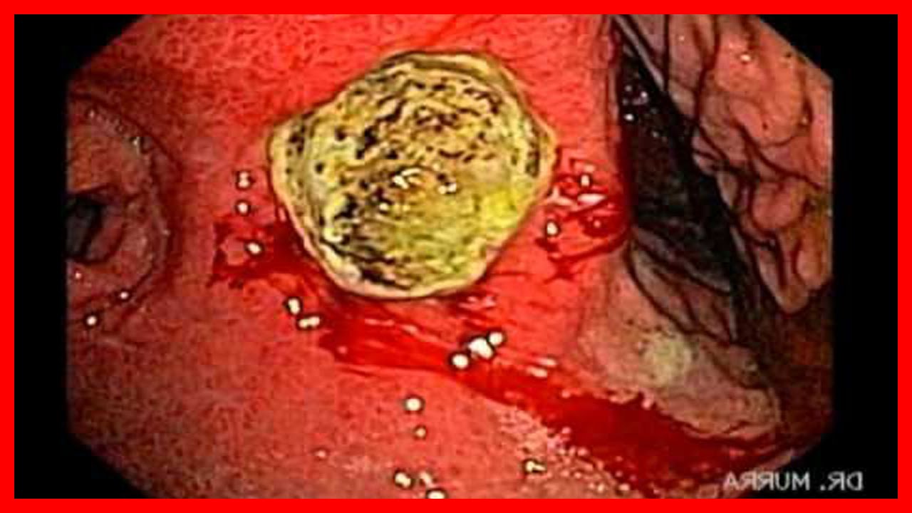 Causas, síntomas, tratamiento, remedios para la Acidez o Pirosis sida origine