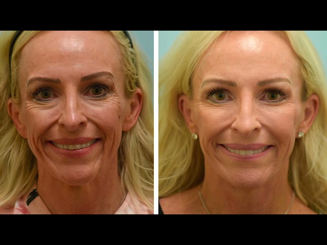 Deep-plane Facelift, Fat Grafting, Upper & Lower Blepharoplasty Testimonial with Before After Photos