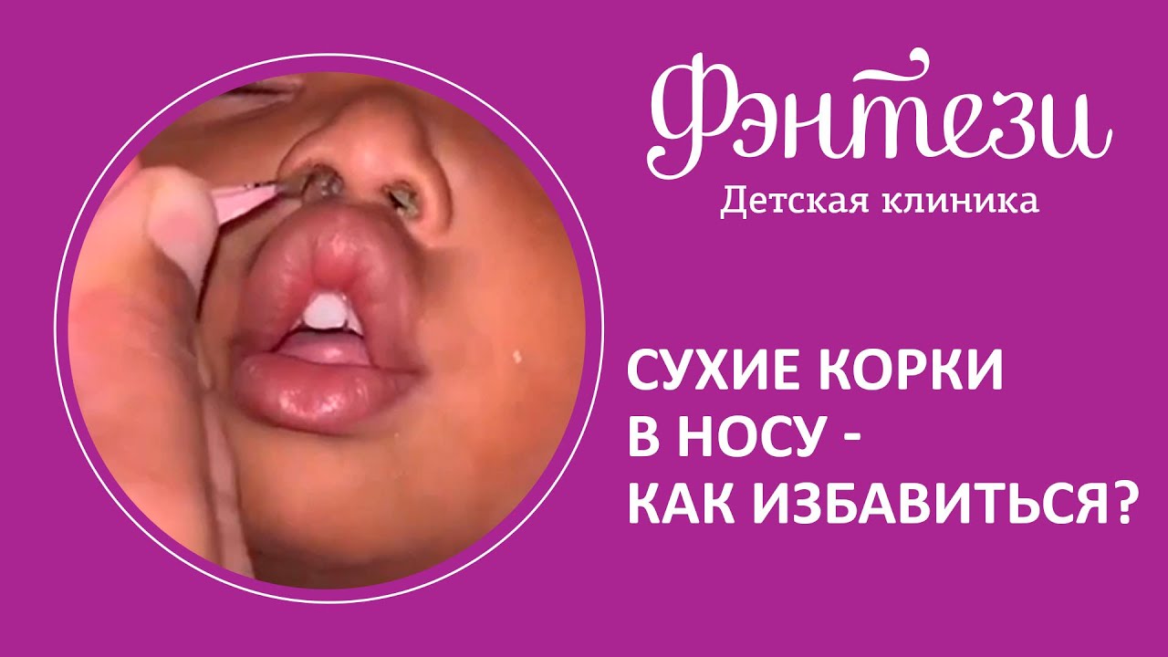 👃 Сухие корки в носу - как избавиться?