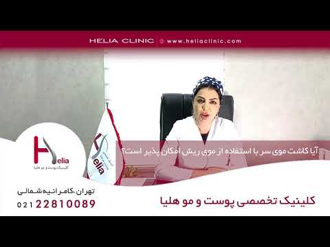 کاشت مو سر با استفاده از موی ریش کلینیک هلیا 09120687738