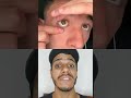 o olho dele caiu