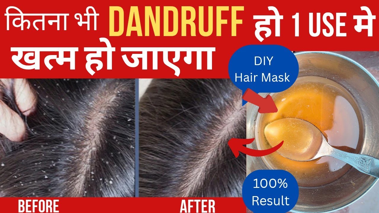 | सिर्फ 1 Use मे Dandruff गायब!😱 | Homemade Anti Dandruff Hair Mask | No Chemicals
