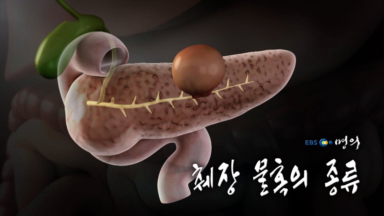 [명의 의학백과📖] 췌장 물혹의 종류 - YouTube