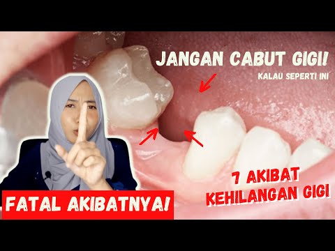 Video: Apakah yang menyebabkan gigi tidak boleh disimpan?