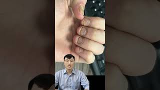 Điều Trị Nấm Móng Tay Chân Bằng Thuốc Khi Nào Nên Bôi? Khi Nào Nên Uống?