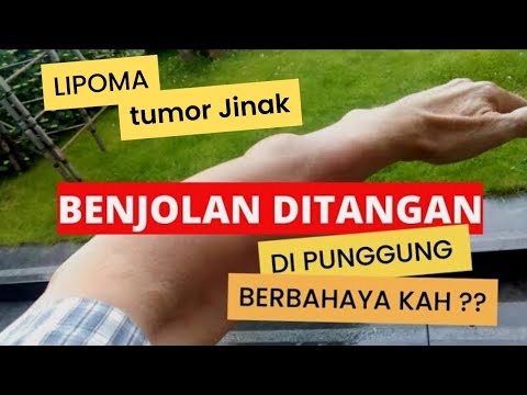 benjolan di punggung dan tangan lipoma