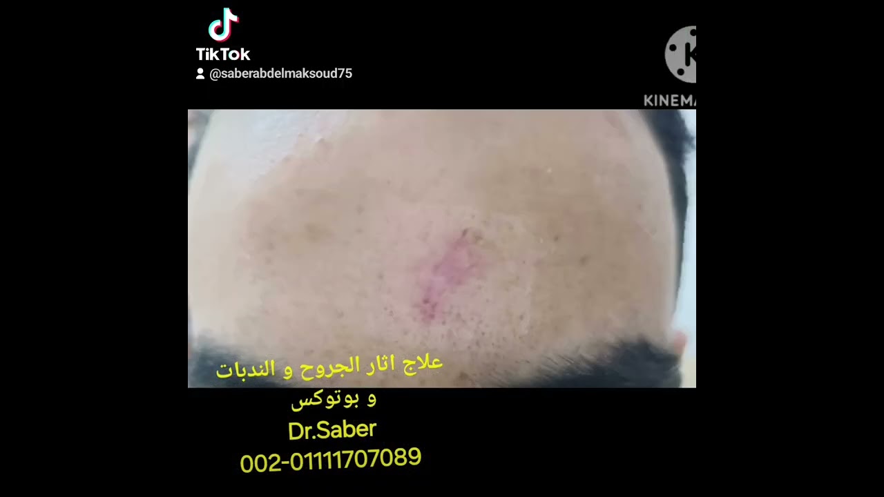 تجميل اثار الجروح و الندبات قبل و بعد ٧ شهور/ أحسن طبيب تجميل مصر/ د.صابر عبد المقصود جراحة التجميل