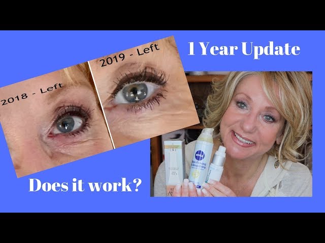 Retin-A and Retinol Treatment for Deep Eye Wrinkles | Before and After