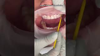 Porcelain veneers procedure | porcelain veneers front teeth | Dr. Yazdan cosmeticdentistry veneers