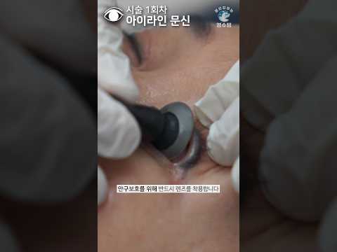 아이라인 문신제거 ASMR ALL 수면마취 Laser Tattoo Removal 