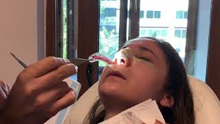 Op Dr Ali Murat Akkuş Rinoplasti Sonrası Silikon Tampon Çıkarılması