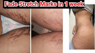 Stretch mark removal / How to remove Stretch marks #stretchmarks #scars #diy