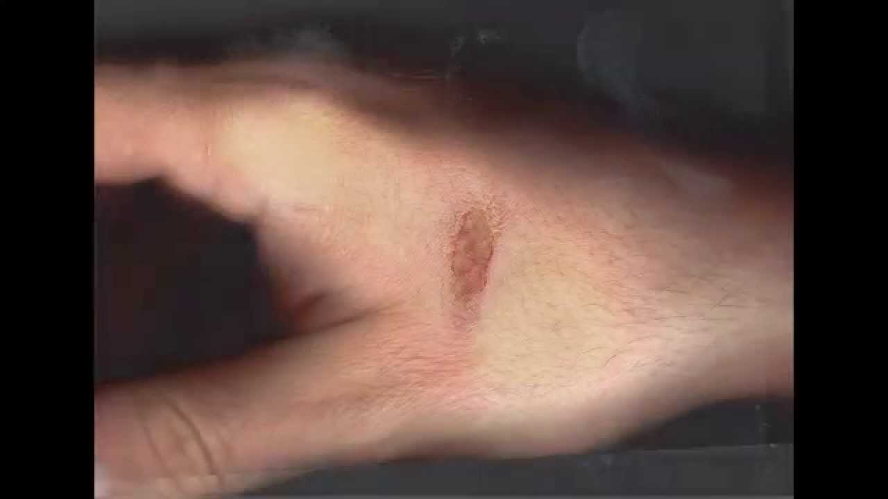 Healing hand time lapse (second version) YouTube