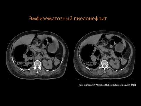 КТ Абдоминальная визуализация  16  Лекция «КТ почек и МВС»  Лектор  Пихута Д А  2