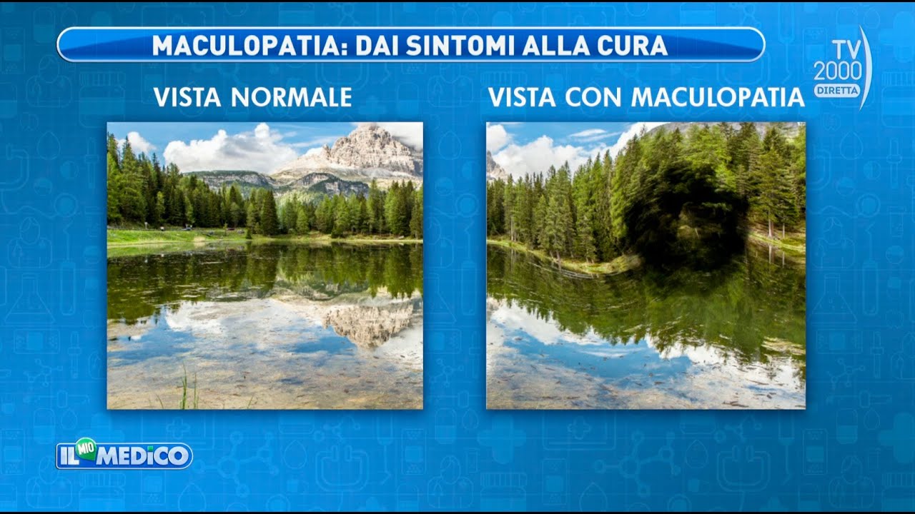 Il Mio Medico (Tv2000) - Terapie e nuove sperimentazioni per curare la maculopatia