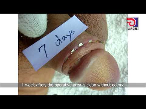 LangHe Medical — Disposable Circumcision Suture Operation Video - Adult