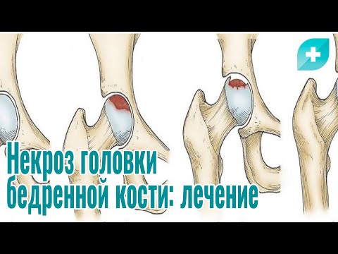 Некроз головки бедренной кости: лечение