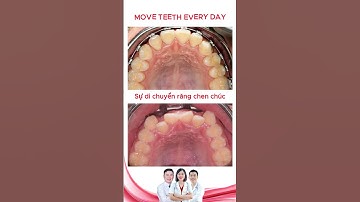 Sự Di Chuyển Răng Chen Chúc Khấp Khểnh | Bác sĩ Thu Gia Lâm