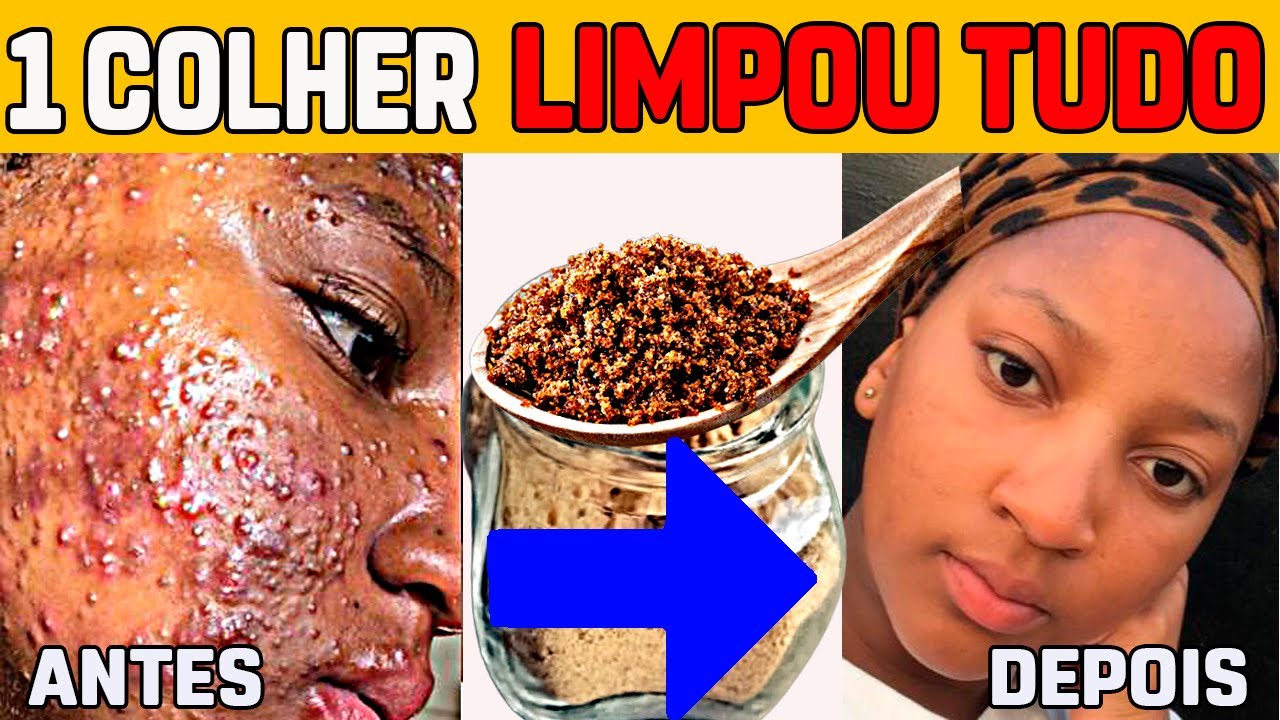 🔵 Este SIMPLES MACETE REMOVE Todas as ESPINHAS e CRAVOS do ROSTO - Como ...