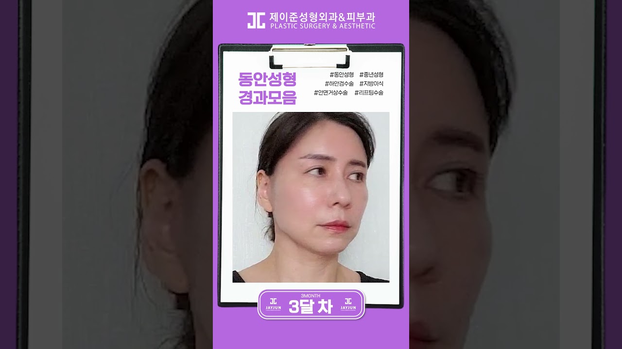 [제이준 성형외과 피부] 10 năm trẻ lại rồi! Từ trung niên thành trẻ trung~♥ | Tổng hợp quá trình thẩm mỹ trẻ hóa #shorts