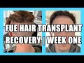 FUE Hair Transplant | Week 1 | Surgery, Swelling, Sleeping, Recovery | Follicular Unit Extraction