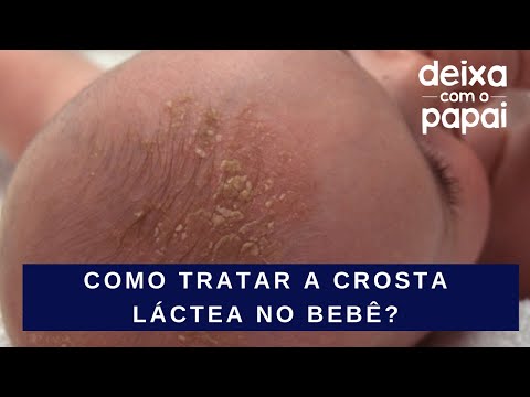 Vídeo: Como Se Livrar De Crostas Na Cabeça De Uma Criança