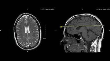 Unremarkable Non-Contrast Brain MRI: Axial T2-Example 1