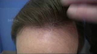 Best Hair Transplants - Dr Wong - 7917 Grafts - 3 Surgery Sessions