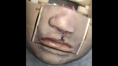 Cleft Lip Simulation #CleftLipSimulation #oralsurgery