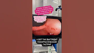 Обнаружили геморрагический гастрит. Пациентку беспокоил зуд в заднем проходе #Shorts